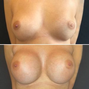 MOTIVA IMPLANTATER 650 ML ROUND